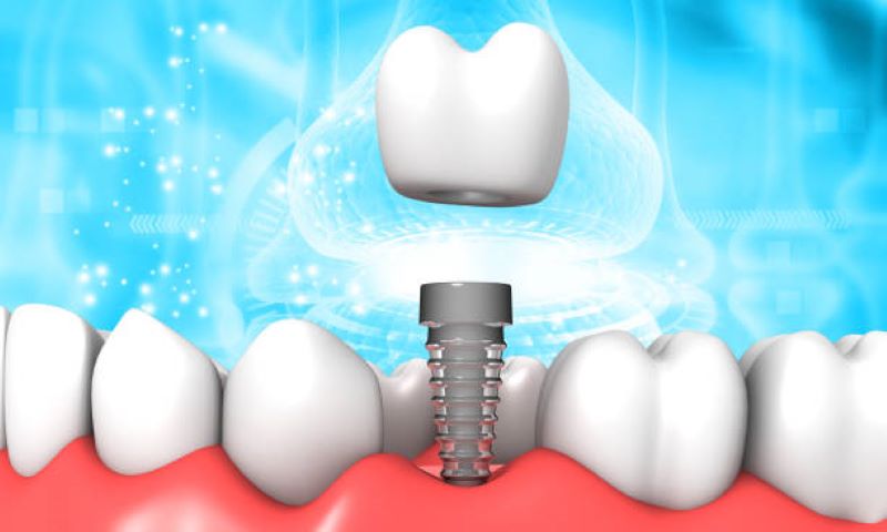 implantati